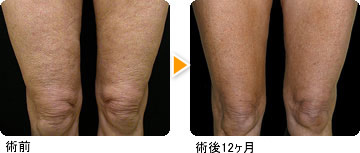 術前 術後12ヶ月