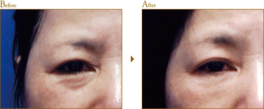 Before After