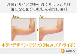 注射針サイズの吸引管でちょっとだけ気になる部分の脂肪を確実に吸引