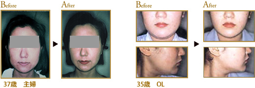 Before After