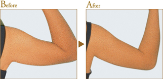 Before After