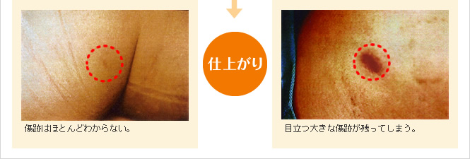 当院開発・当院特許KBシースを使用した場合」と「KBシースを使用しなかった場合の比較」
