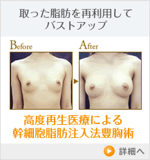 高度再生医療による幹細胞脂肪注入法豊胸術