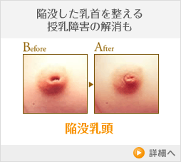 陥没乳頭