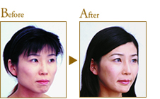 Before After