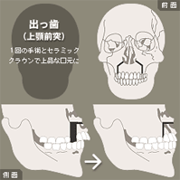 出っ歯(上のあごが出ている方)