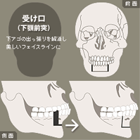 受け口(下のあごが出ている方)