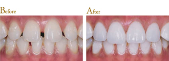 Before After