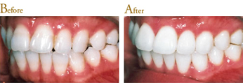 Before After