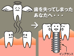 共立式インプラント治療とは?