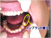 インプラントの埋め込み