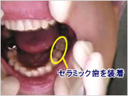セラミック歯を装着