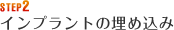 STEP2 インプラントの埋め込み
