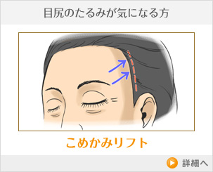 こめかみリフト