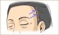こめかみリフト 目尻のたるみが気になる方