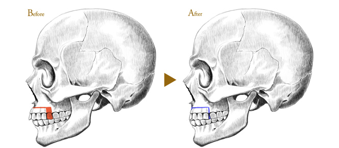 Before After