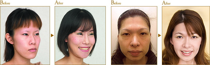 Before After