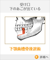 受け口 下のあごが出ている