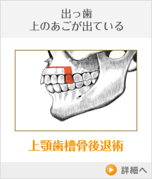 出っ歯 上のあごが出ている