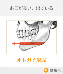 あごが長い、出ている