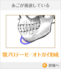 あごが後退している