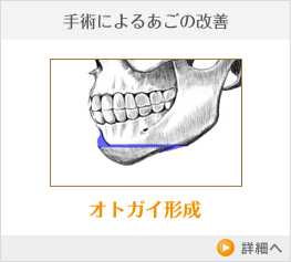 手術によるあごの改善 オトガイ形成