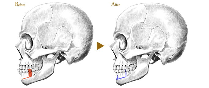 Before After