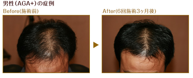 男性(AGA+)の症例 Before(施術前) After(6回施術3ヶ月後)