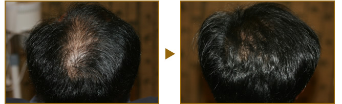 男性(AGA+)の症例 Before(施術前) After(6回施術3ヶ月後)