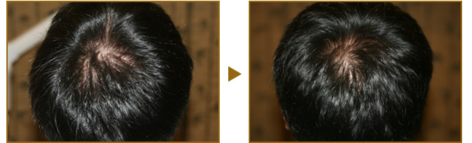 男性(AGA-)の症例 Before(施術前) After(4回施術4ヶ月後)