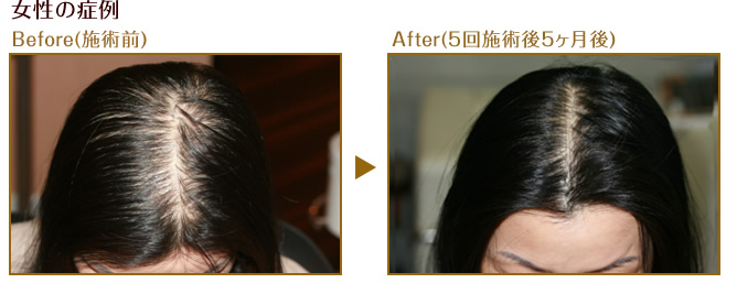 女性の症例 Before(施術前) After(5回施術5ヶ月後)
