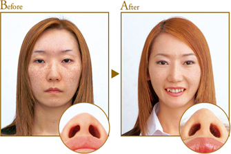 Before After