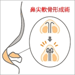 鼻尖軟骨形成術