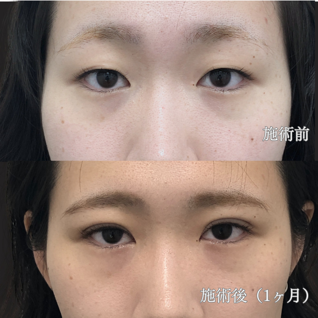 24歳女性｜自然癒着法ダブルモアで平行二重を実現