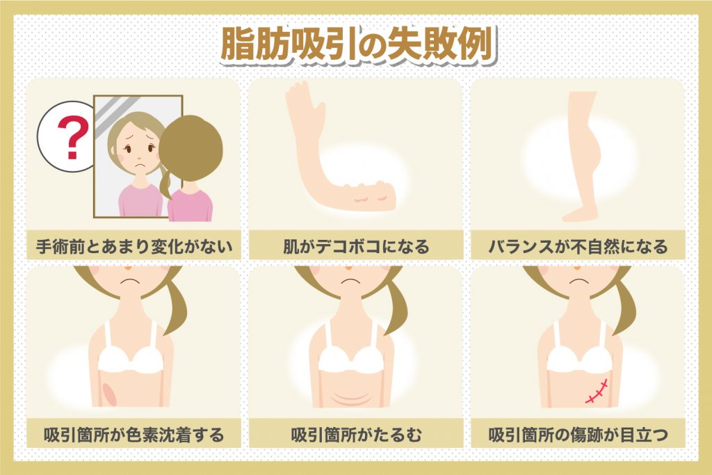 脂肪吸引で失敗することがあるって本当 ありがちな失敗と信頼できるクリニック選びのポイントを解説 共立美容外科 公式コラム 美容整形 美容医療専門クリニック