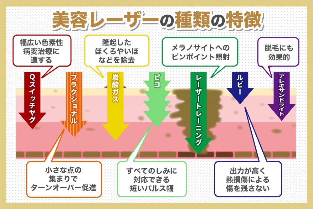 レーザー脱毛の仕組み