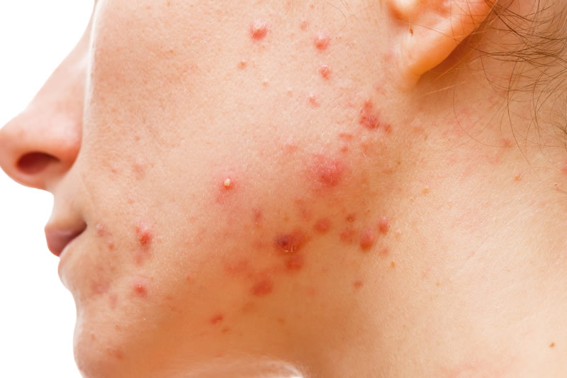 ニキビ跡ってキレイに治す方法はあるの 共立美容外科 公式コラム 美容整形 美容医療専門クリニック