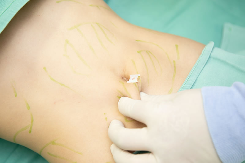 手術室でお腹をつまむ医師