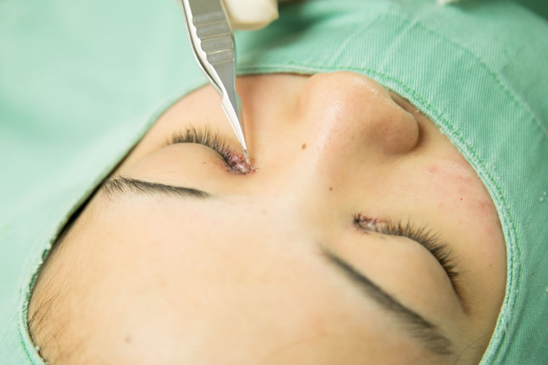 足の古い傷跡を治療する