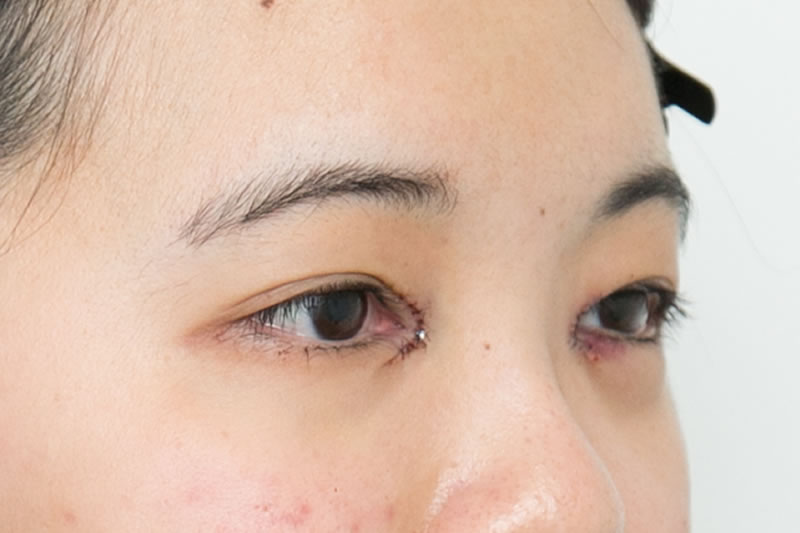 目頭切開の手術後の傷跡