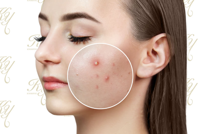 ニキビを潰すのは良くない 早く治るというのはウソだった 共立美容外科 公式コラム 美容整形 美容医療専門クリニック ニキビを潰すのは良くない 早く治るというのはウソだった 共立美容外科 公式コラム 美容整形 美容医療専門クリニック