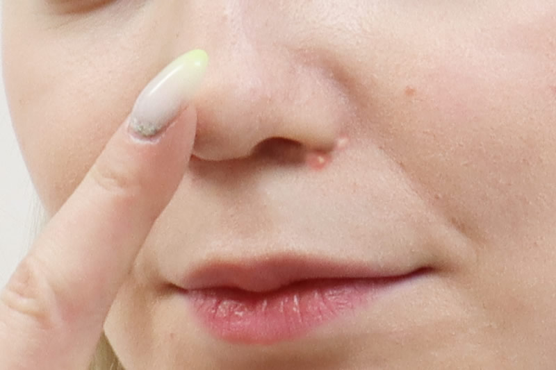 ニキビの場所ごとに原因が違う 男女別でできやすい部位を美容外科医が解説 共立美容外科 公式コラム 美容整形 美容医療専門クリニック