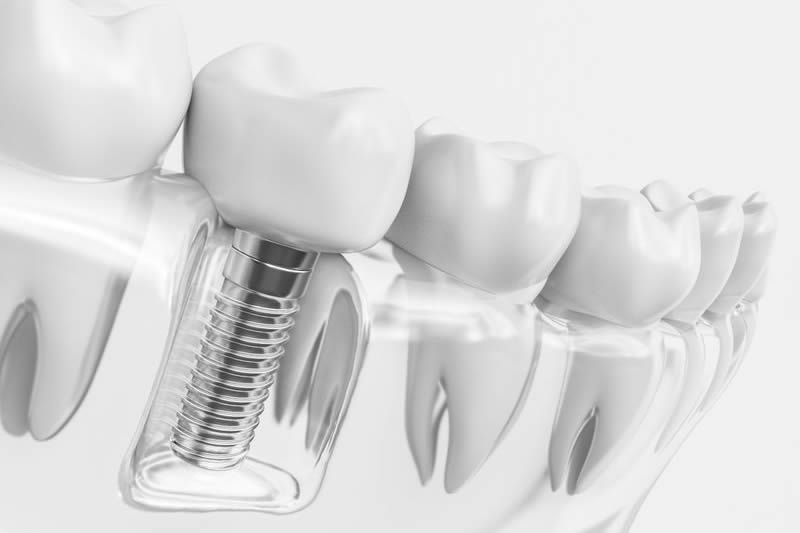 インプラントのデメリットやリスクについて歯科医師が解説