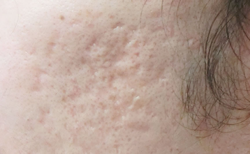 クレーター状のニキビ