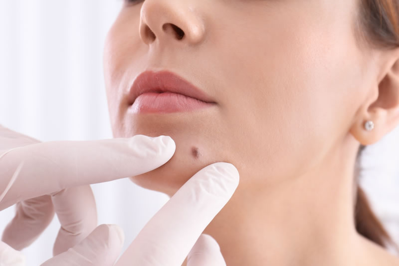 顔のほくろが増える原因とは？予防法や消す方法を美容外科医が解説