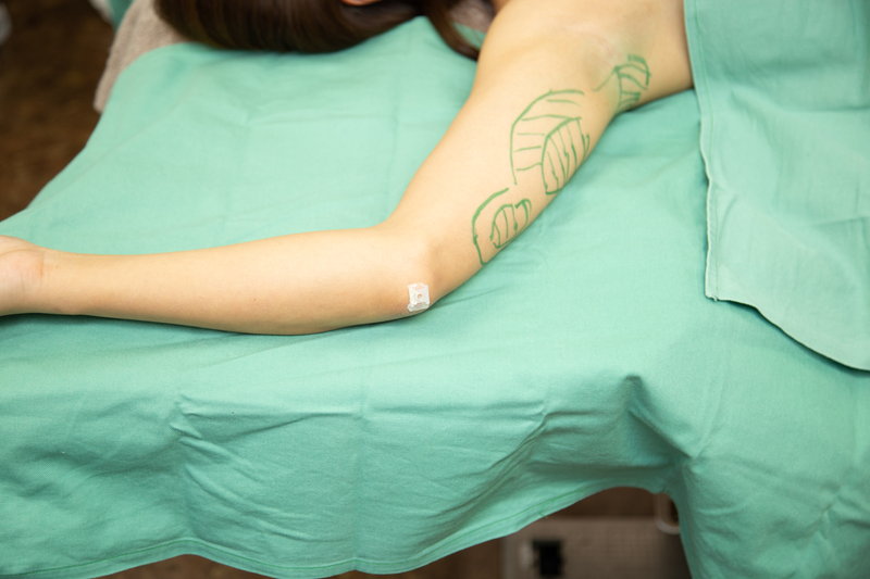 手術室で二の腕の脂肪吸引をすることろ