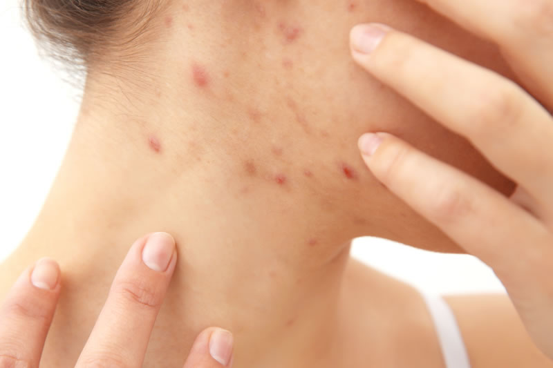 色素沈着したニキビ