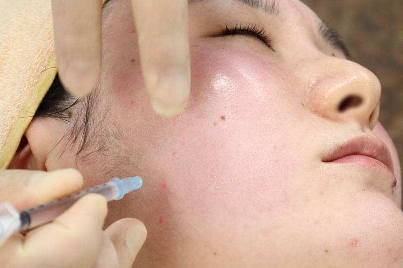 エラボトックスの効果が出始め時期や持続期間を美容外科医が解説 共立美容外科 公式コラム 美容整形 美容医療専門クリニック