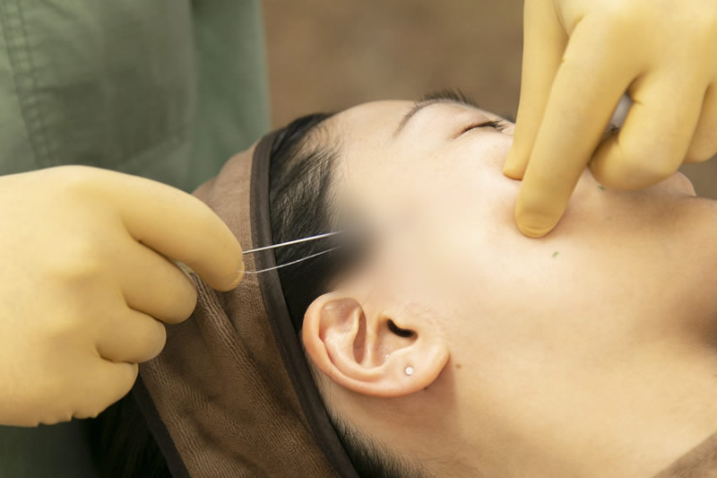 糸リフトの手術を受けている患者