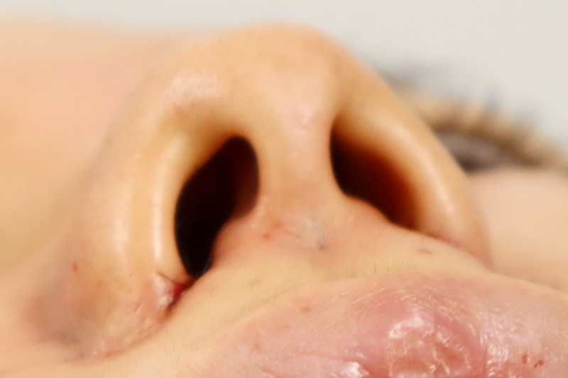 内側切開による小鼻縮小の直後の腫れや内出血の状態（横）